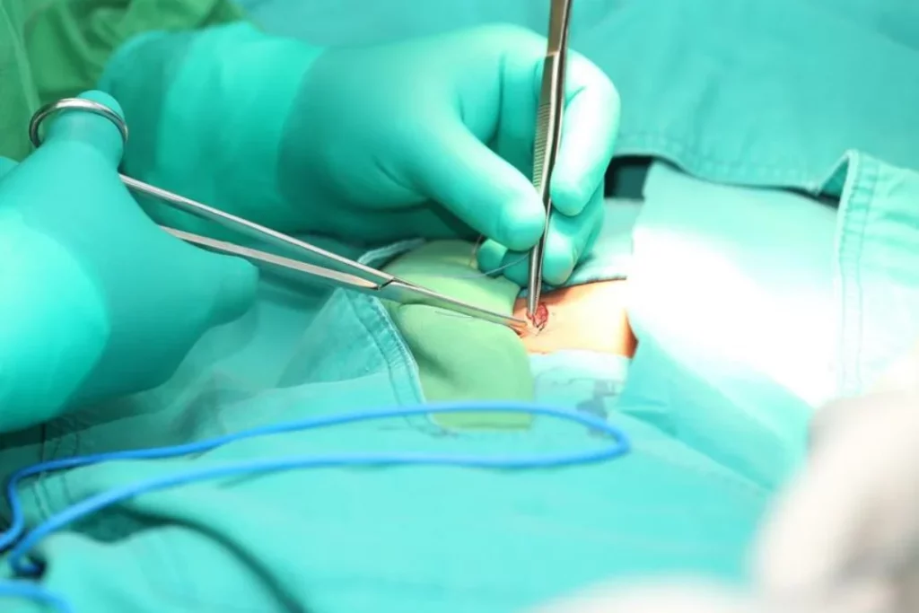 Open surgery vs laparoscopic