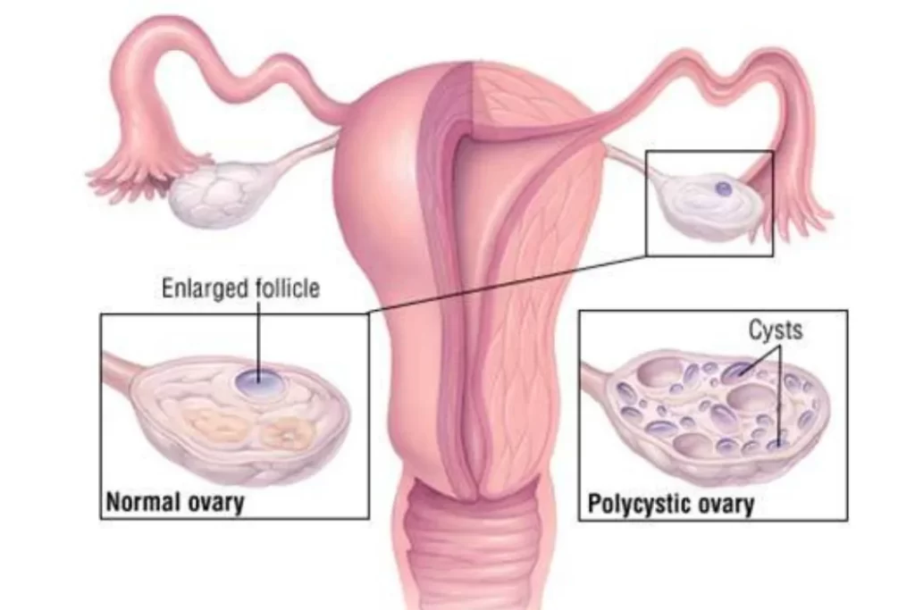 Polycystic Ovary Syndrome