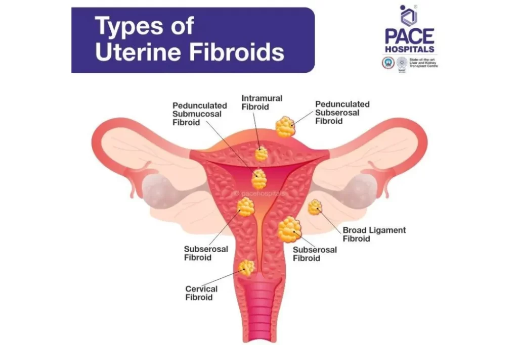 Types of uterine fibroid