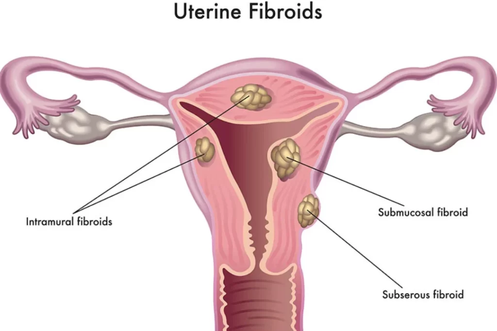 Uterine Fibroids