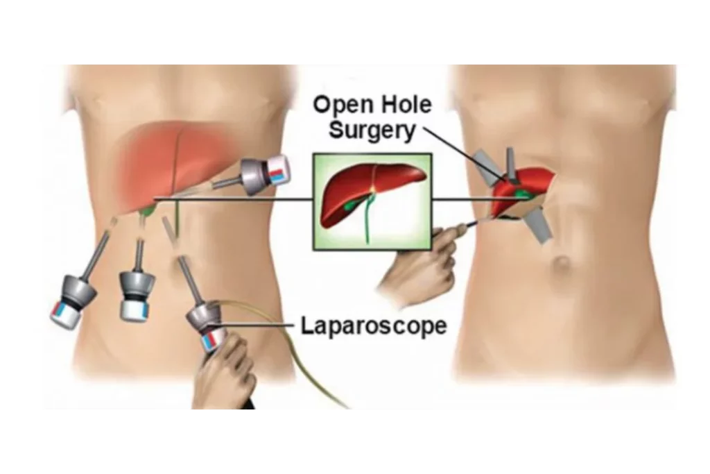open surgery vs laparascopic