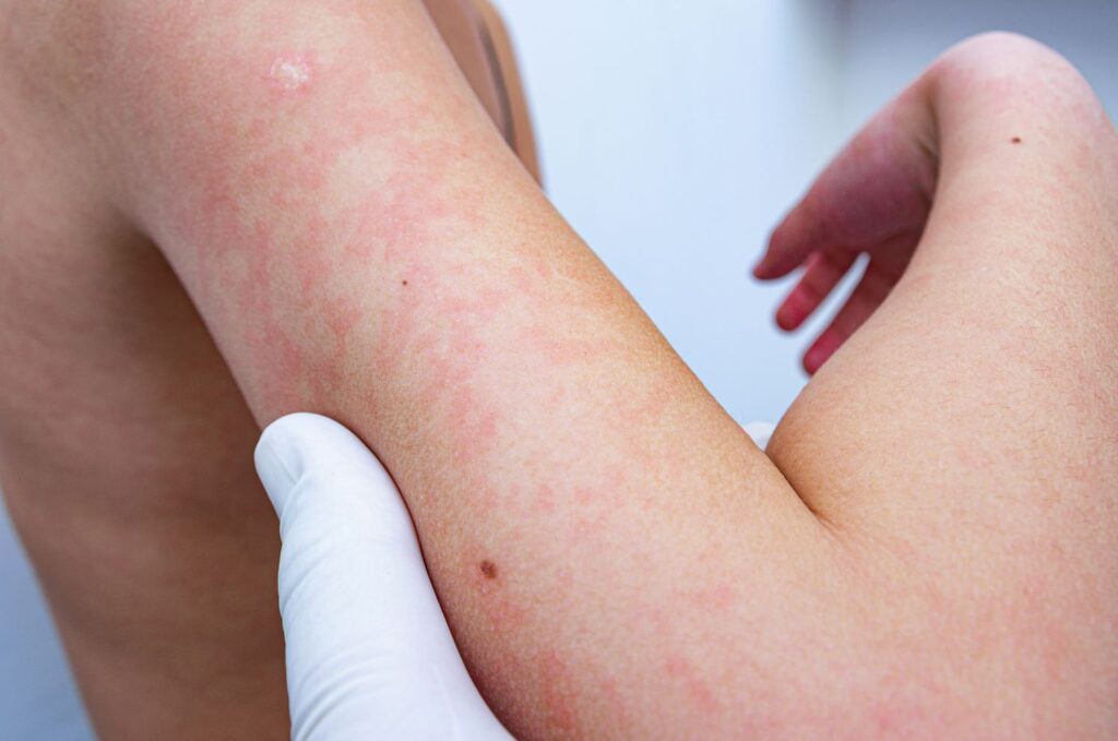 Prevent Prickly Heat Rash with Aloe Vera Gel Natural Remedy