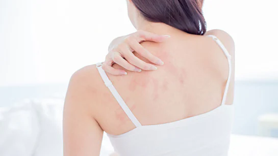 Prevent Prickly Heat Rash with Aloe Vera Gel Natural Remedy