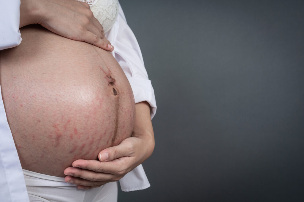 The Truth About Stretch Marks During Pregnancy | Facts & Care